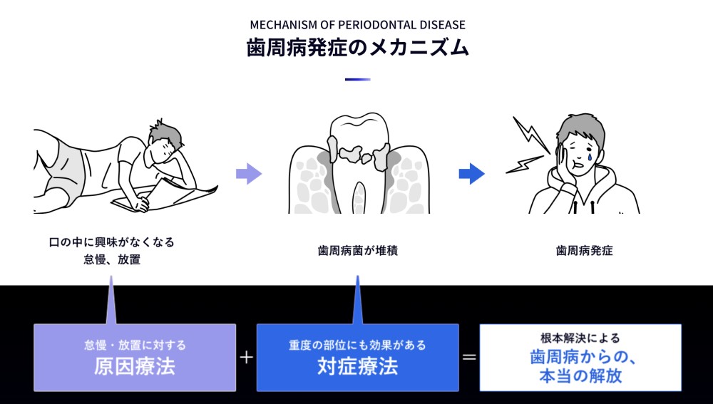 歯周病発症のメカニズムの図