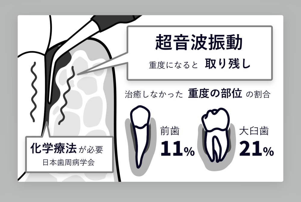 超音波振動のみでの歯周病治療イメージ
